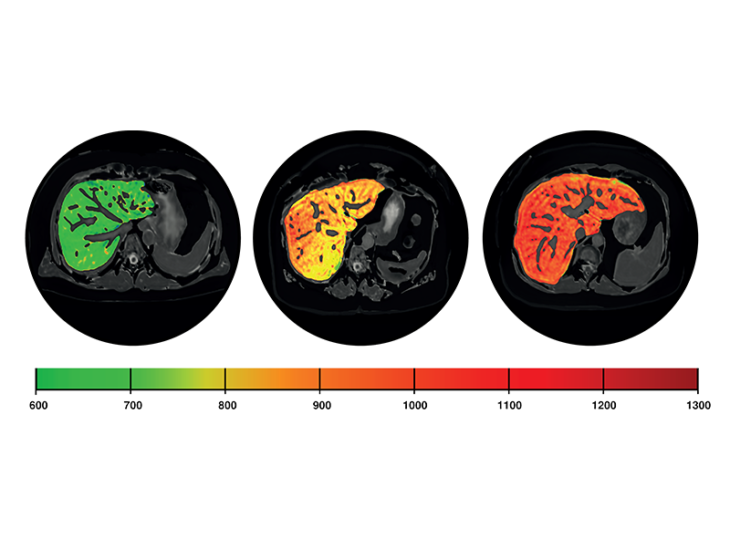 MASLD/MASH & Cirrhosis