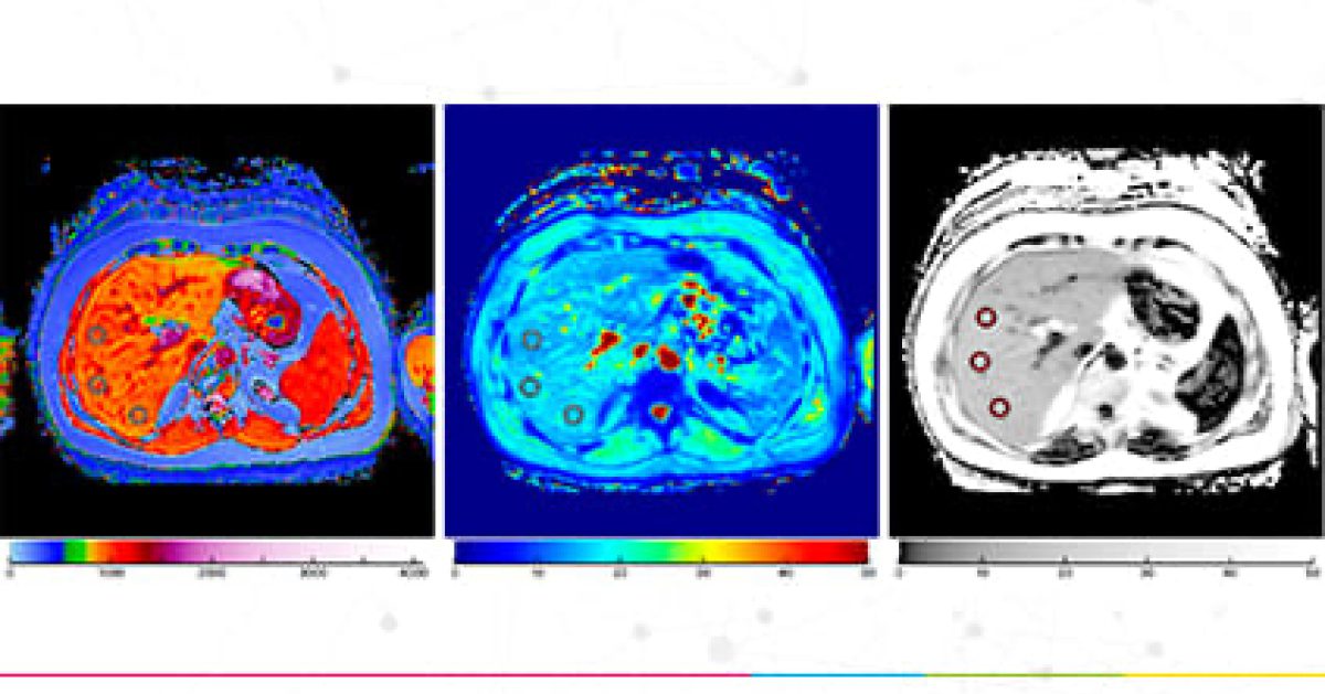 Pmri Multi-Parametric MRI Can Predict Clinical Outcomes, New Data Reveals ...