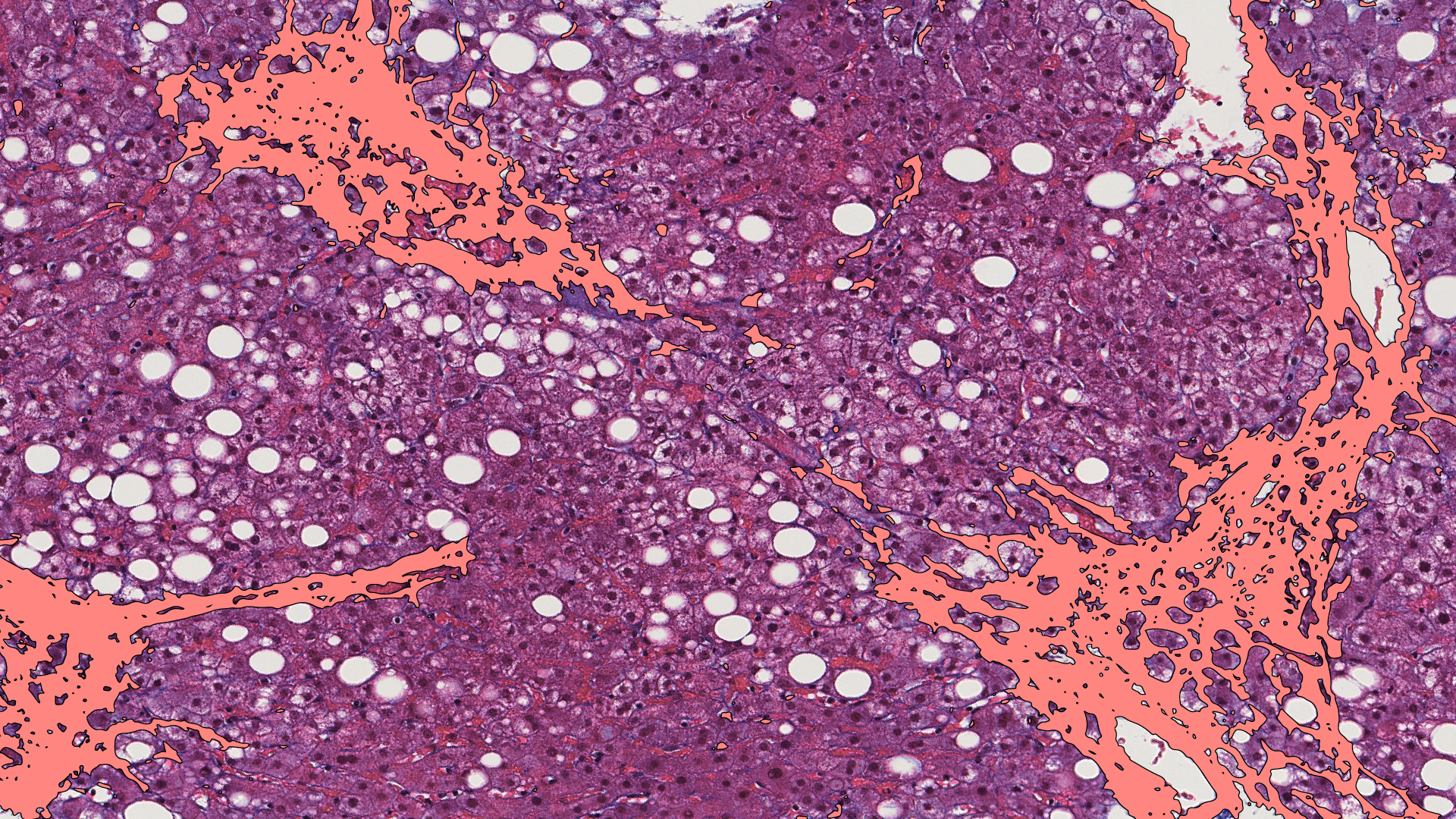Trichrome slide with PAIR MASH fibrosis delineation